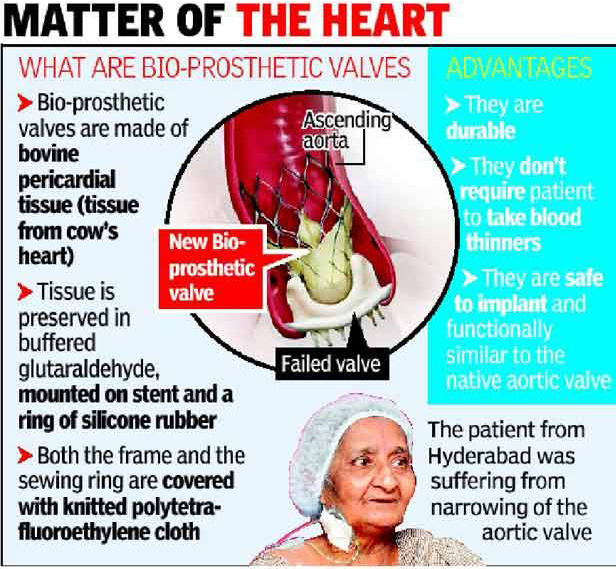 Cow heart valve to woman, Cow heart, Heart Operations