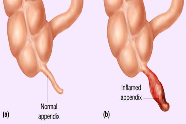 Appendicitis Causes