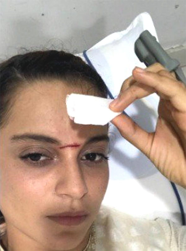 Kangana Ranaut Injured at Manikarnika Shooting