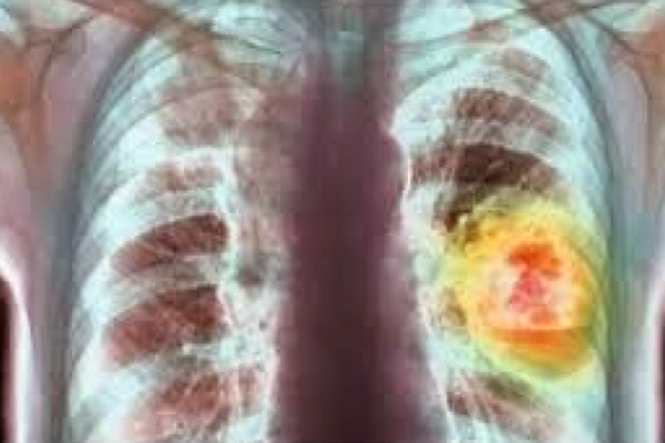 Risks Of Lung and Bronchus Cancer