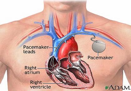pacemaker-1