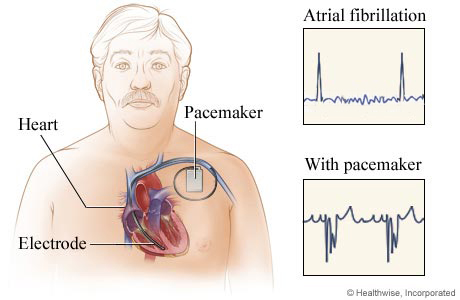 pacemaker-4