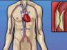 heart attack, heart attack, revolutionary heart surgery with 10 grafts, Revolution