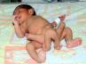 Baby with six legs, Pakistan, baby with 6 legs, Cosmetic