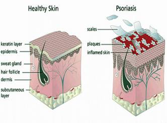 What is psoriasis? Want to know?
