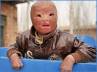 fire accident, fire accident, boy in china with burnt face, Conservative