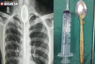 Chinese Man Swallows Spoon: Stuck In For A Year