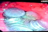 Coins in man's stomach, man's stomach, 63 coins recovered from a man s stomach in jodhpur, Rs 4 cr recovered