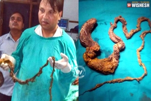 Five foot hairball found in the stomach