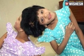 Veena-Vani, future, niloufer hospital asks govt to decide on conjoined twins, Conjoined twins