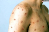 Monkeypox cases, Monkeypox Kerala, india confirms its second monkeypox case, Coronavirus