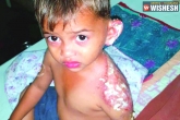 kid, Minor, minor boy sets ablaze 3 year old kid for not giving way, Minor boy