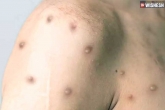 Monkeypox breaking updates, Monkeypox study, monkeypox found in semen and is sexually transmitted, Smit