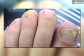Nail fungal infections prevention, Nail fungus, all about nail fungus and why nails turn yellow, Tips