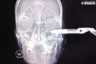 Pair of scissors sticking out of the head