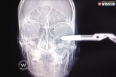 x ray, weird news, pair of scissors sticking out of the head, Pair up