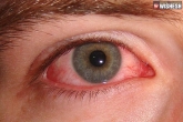conjunctivitis, Pink eyes latest, pink eyes the primary symptom of coronavirus, Toco