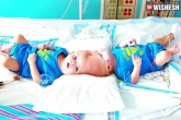 Anias, Anias, rare conjoined twin boys undergo surgery seperated after 27 hrs, Boys