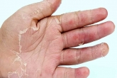 Skin Peeling on Hands reasons, Skin Peeling on Hands medicine, five causes of skin peeling on hands, Symptoms