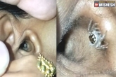Spider in ear, bengaluru Spider in ear, bengaluru woman complains of headache spotted spider in her ear, Spider