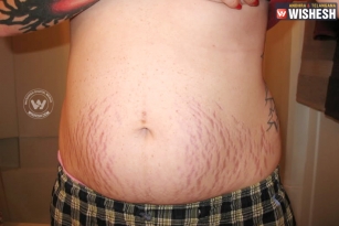 Stretch marks are troublesome issue for new mothers