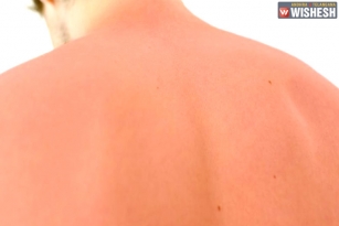 Tips and Treatment for Sunburn