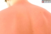 Sunburn prevention, Sunburn latest, tips and treatment for sunburn, Summer