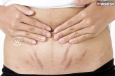 How to lighten stretch marks, Here is the way to lighten your stretch marks, tips to lighten stretch marks, Naturally