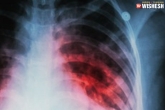 Tuberculosis medication, Tuberculosis symptoms, all about tuberculosis and its treatment, Diet