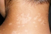 White Patches On Skin breaking, White Patches On Skin latest breaking, what are the indications white patches on skin, Ent