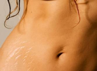 Tips to getting rid of stretch marks...