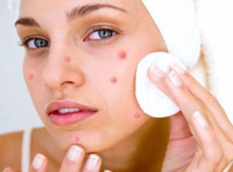 PIMPLE... a hurdle for your beauty...