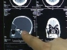 boy's skull, Nakul Bhargava, delhi doctors removed bullet from boy s skull after 27 hours, Doctors remove 14 cm