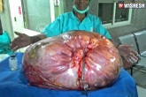 weird news, UP news, 95kg tumour in woman s stomach removed in up, Stomach