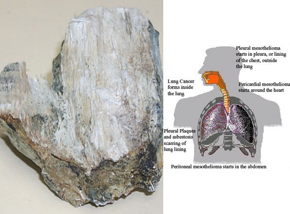 India’s Toxic Import from Canada, Asbestos