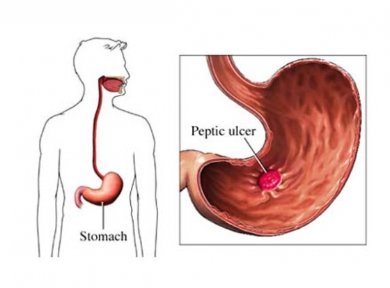 All about Peptic Ulcers...