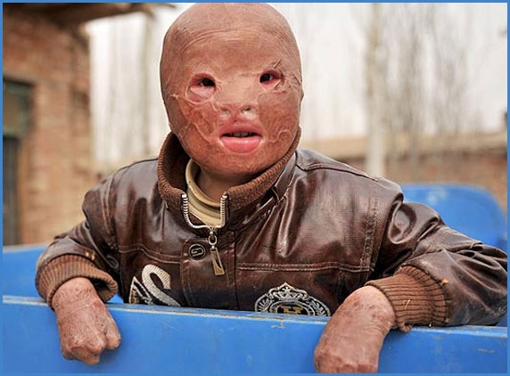 Boy in China with burnt face