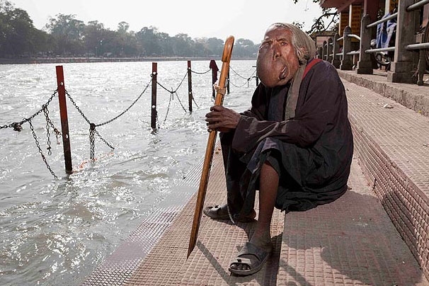 A painful story of a half-faced man